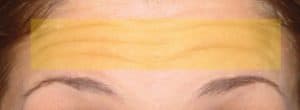 Forehead Lines