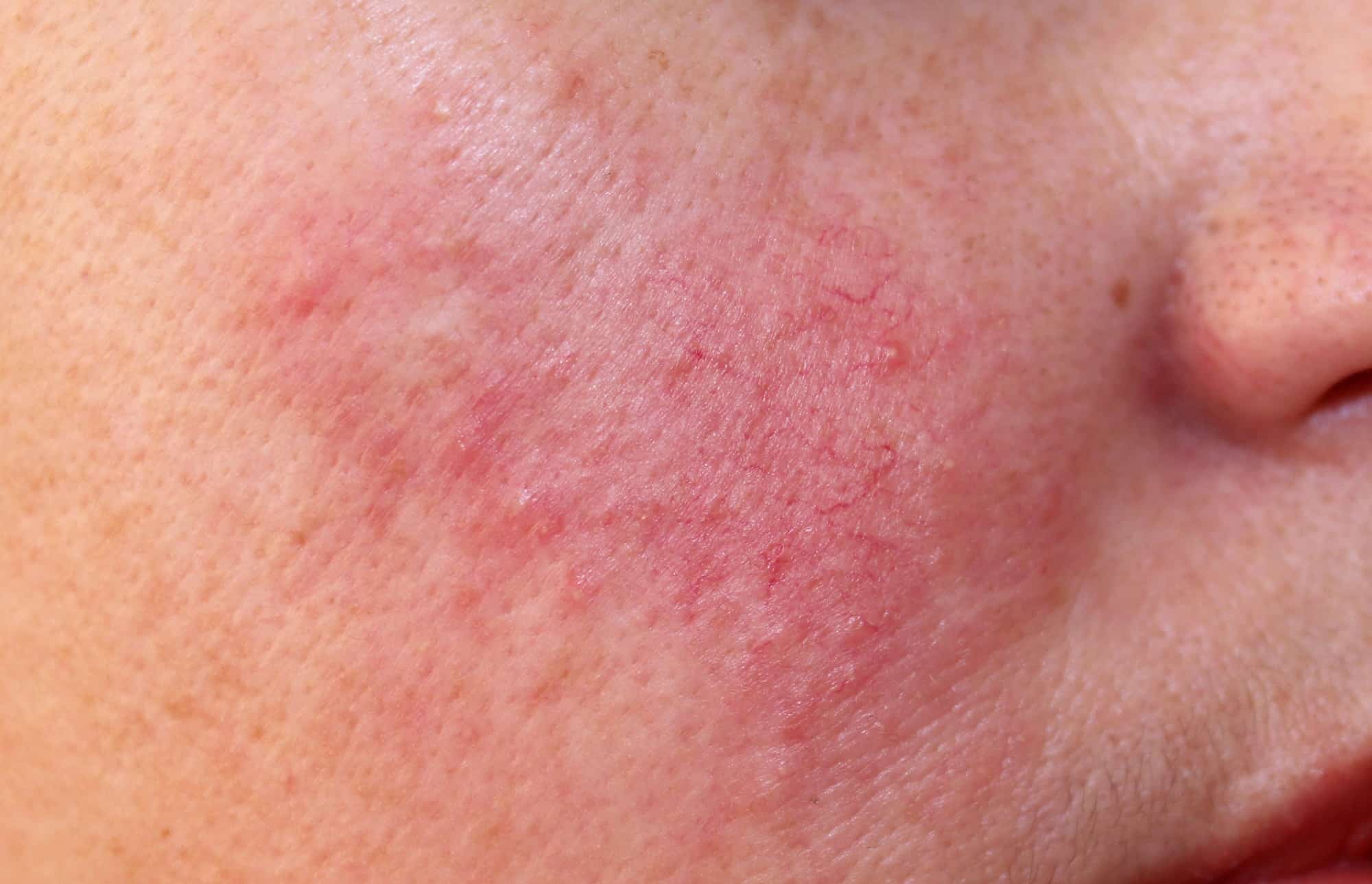 Rosacea Laser Treatment in Boca Raton