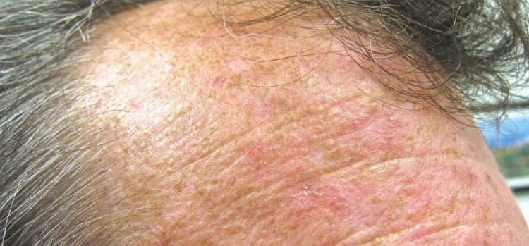 Actinic Keratosis Treatment in Boca Raton