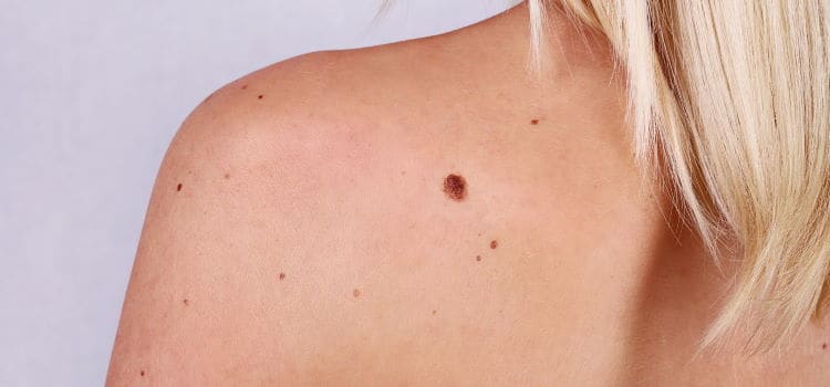 Skin Moles Screening in Boca Raton