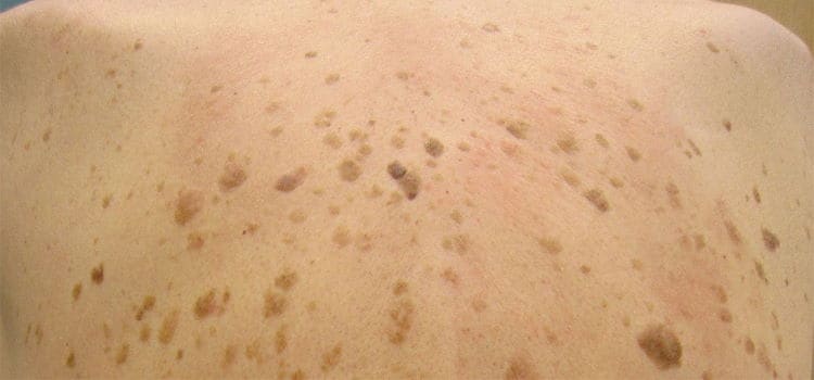 Seborrheic Keratosis Treatment in Boca Raton