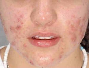 Acne Treatment in Boca Raton Before