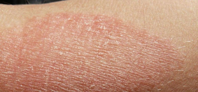 Eczema (Atopic Dermatitis) Treatment in Boca Raton