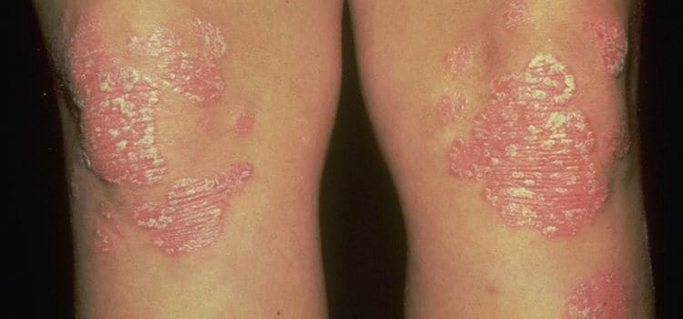 Psoriasis Treatment Specialists in Boca Raton