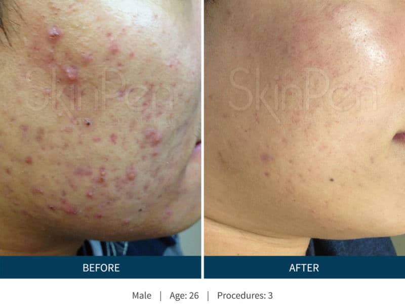 SkinPen Before and After