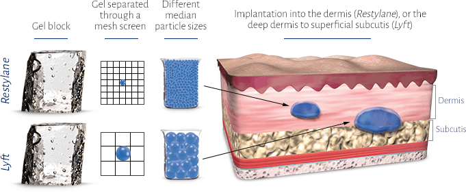 How Restylane Works