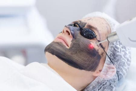 Hollywood Laser Peel