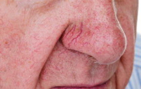 Facial Spidel Veins Laser Laser Treatment in Boca Raton