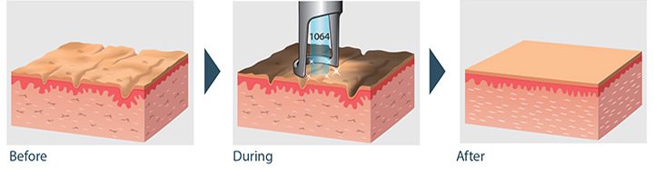 How Spectra Hollywood Laser Peel Works