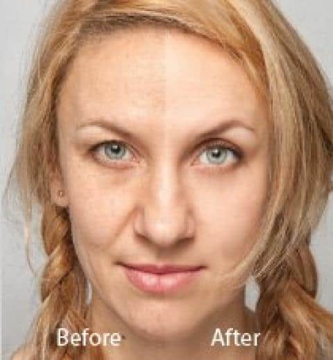Hollywod Spectra Laser Peel Before and After