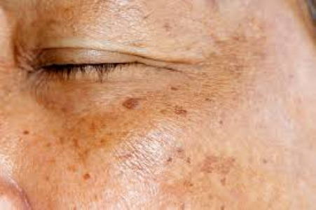 Sun Damage and Brown Spots