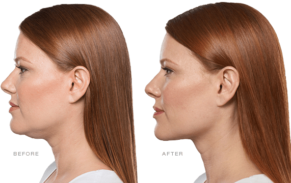 Kybella Injections Before and After