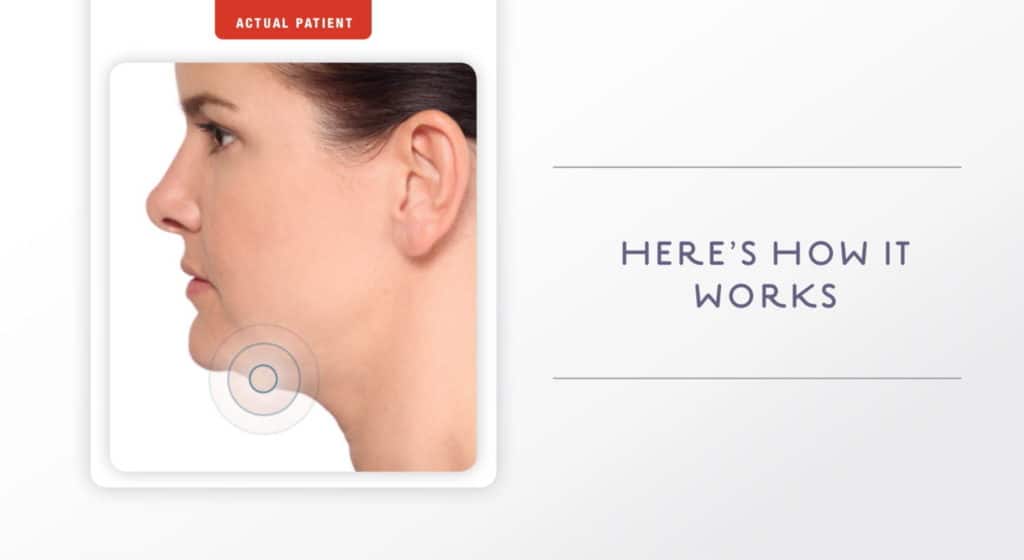 How Kybella Works