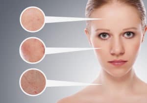 IPL Therapy in Boca Raton