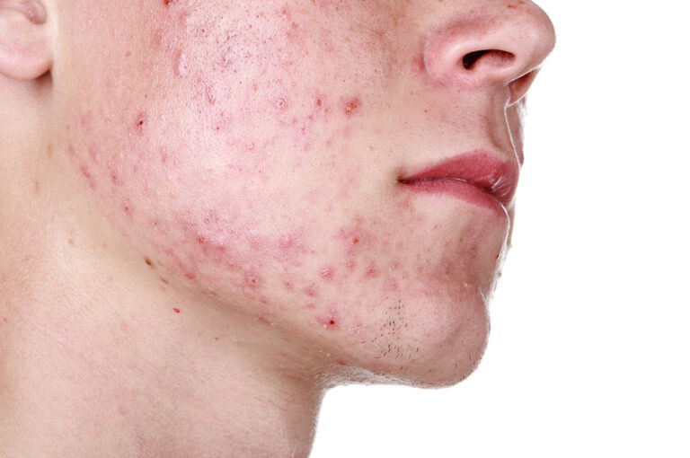 Acne, Boca Raton FL