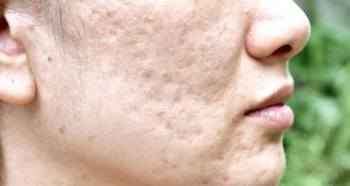 Acne Scars Treatment in Boca Raton