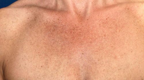 Decolletage Anti-Aging Treatment in Boca Raton