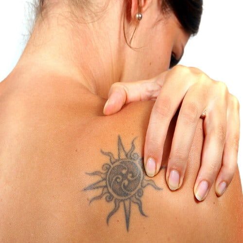 Laser Tattoo Removal in Boca Raton