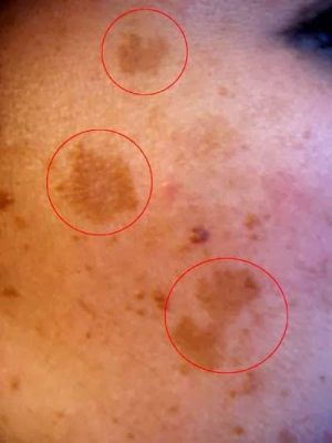 IPL for Melasma Treatment